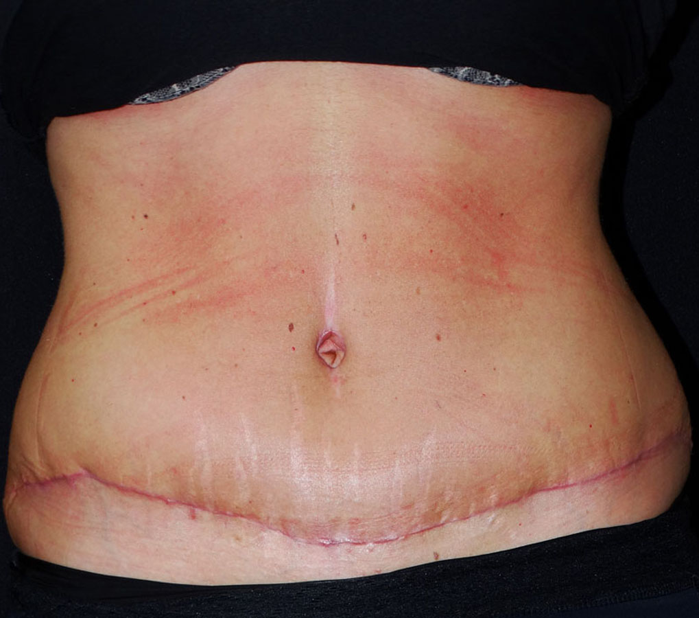 The Tummy Tuck Scar and Dr. Patronella's TRUE FORM ABDOMINOPLASTY® Scar  Treatment - Houston, Texas
